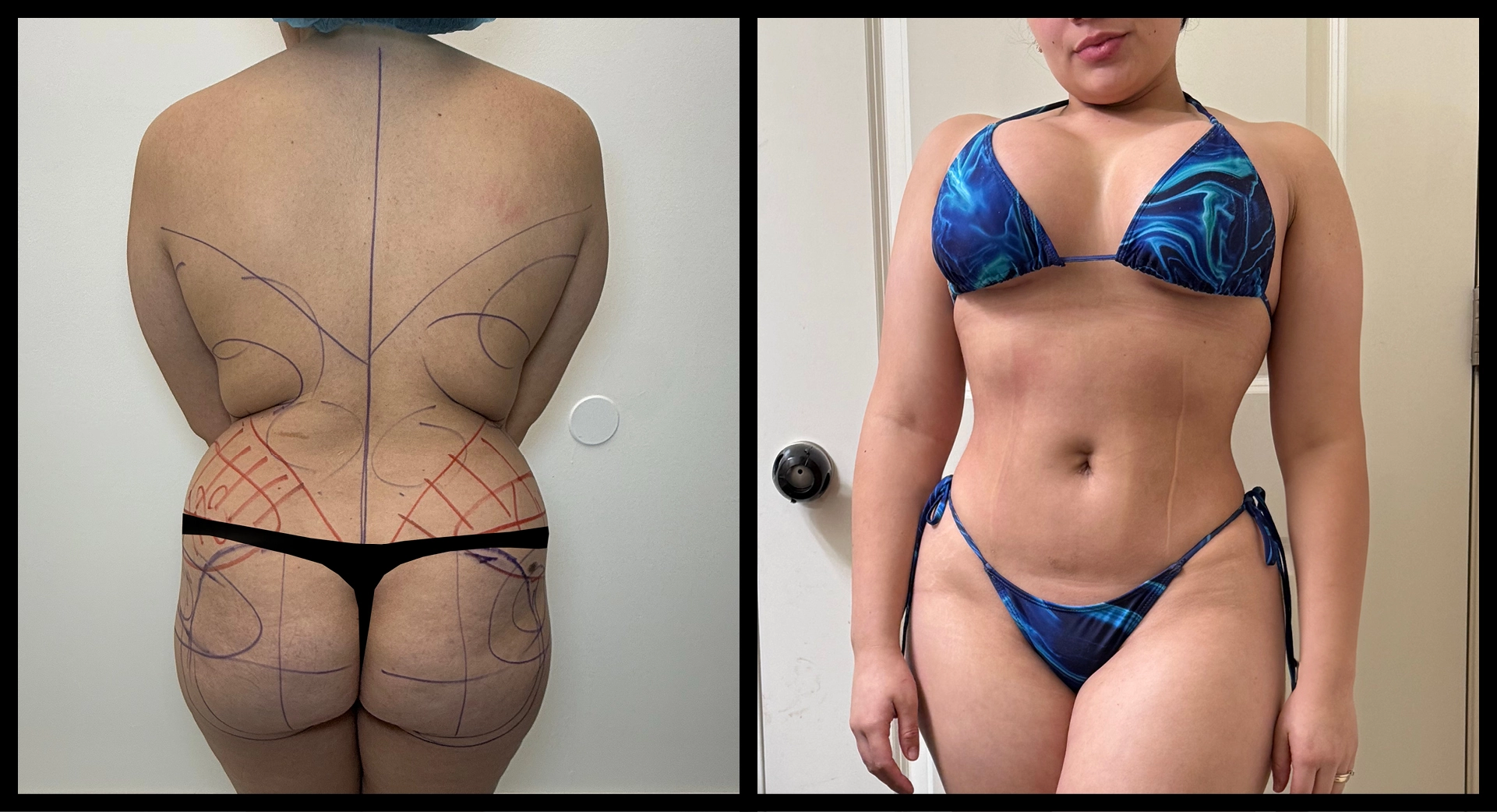 BBL Reversal before and after photo 1 - safe reduction results at Elevé Cosmetic Surgery Miami