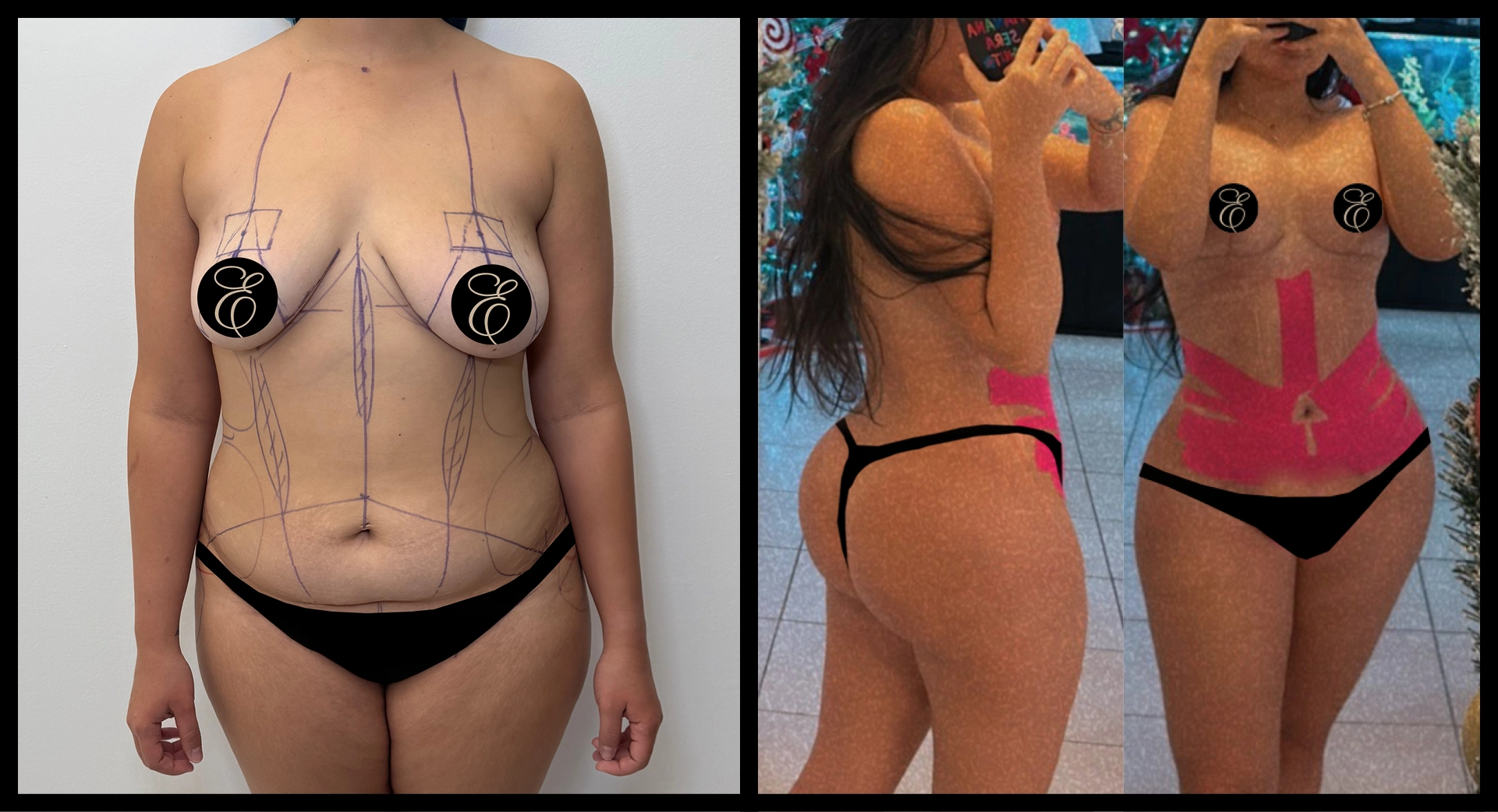 BBL Reversal before and after photo 3 - safe reduction results at Elevé Cosmetic Surgery Miami