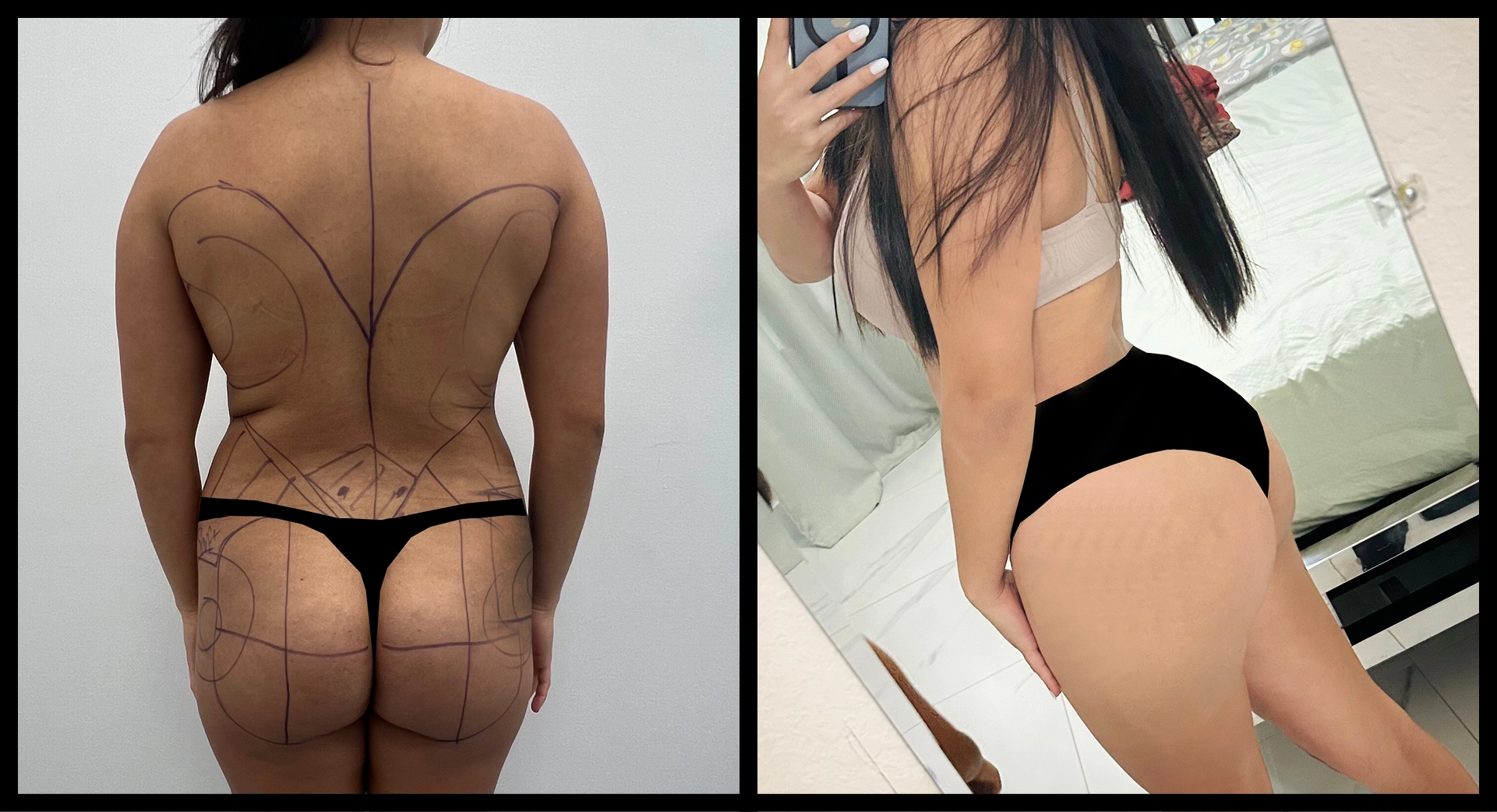 BBL Reversal before and after photo 4 - safe reduction results at Elevé Cosmetic Surgery Miami