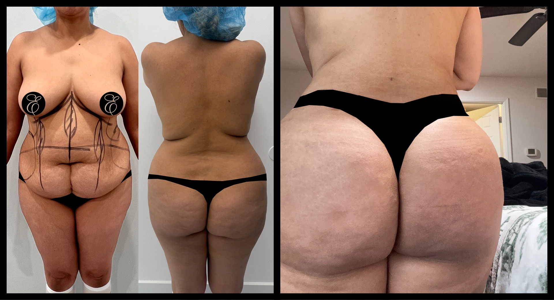 BBL Reversal before and after photo 5 - safe reduction results at Elevé Cosmetic Surgery Miami