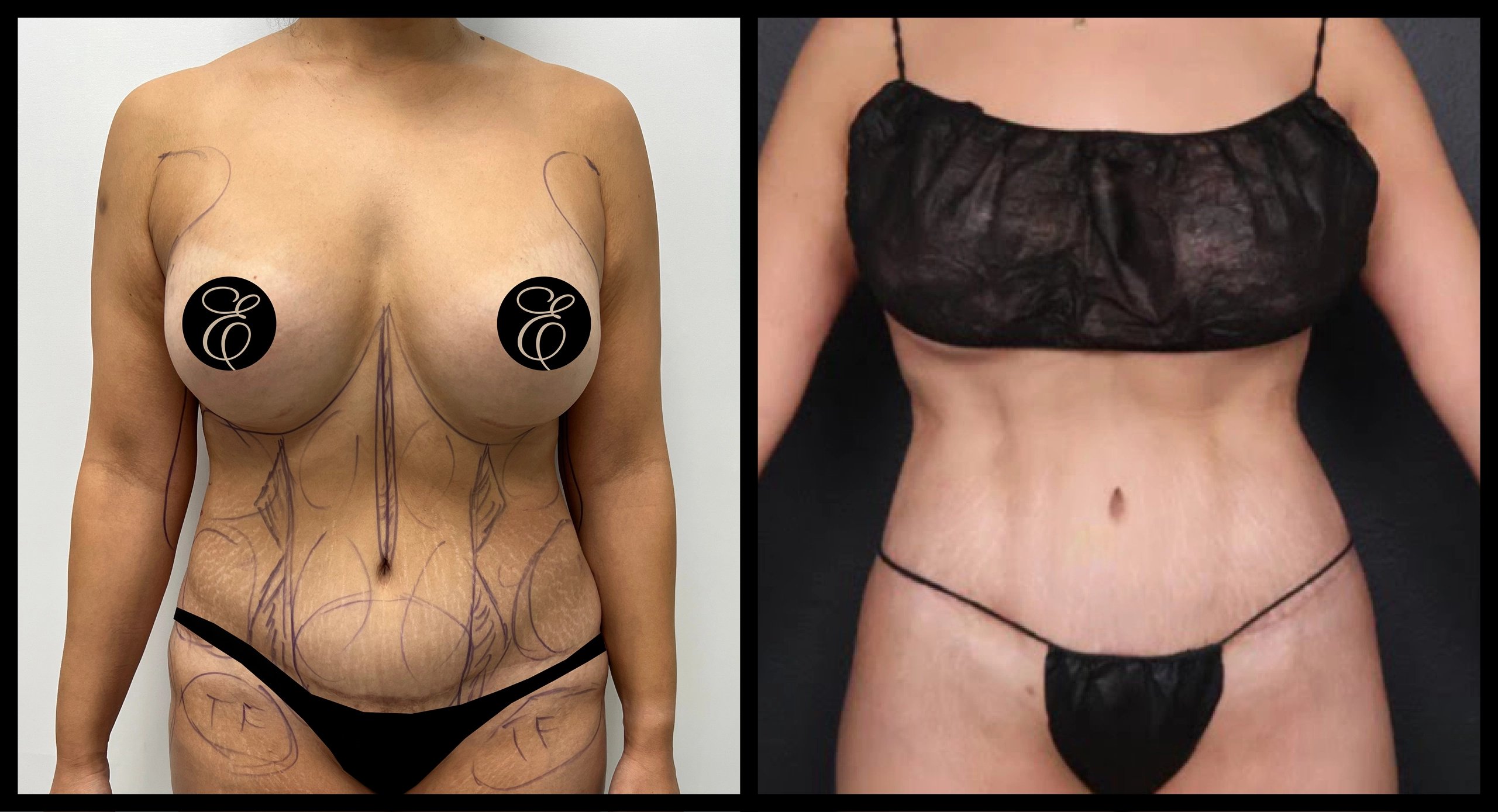 BBL Reversal before and after photo 6 - safe reduction results at Elevé Cosmetic Surgery Miami