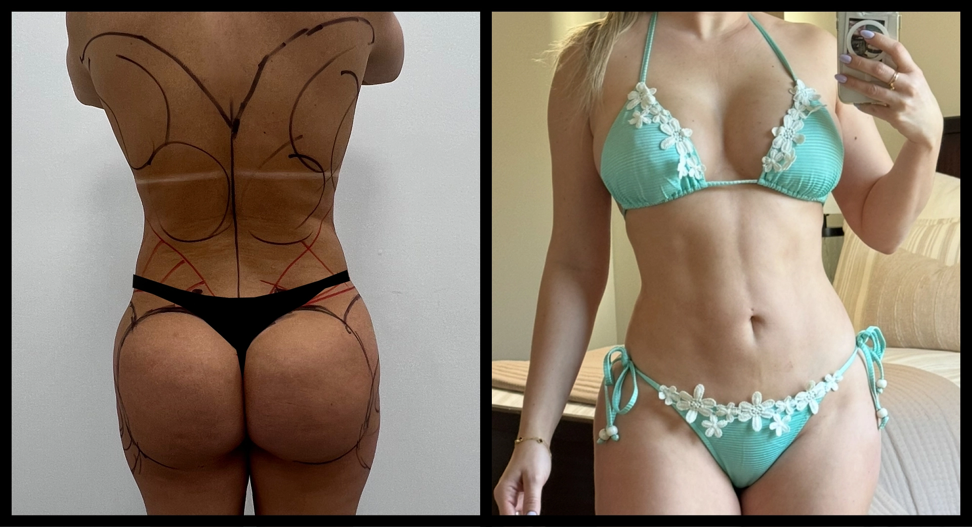 BBL Reversal before and after photo 7 - safe reduction results at Elevé Cosmetic Surgery Miami