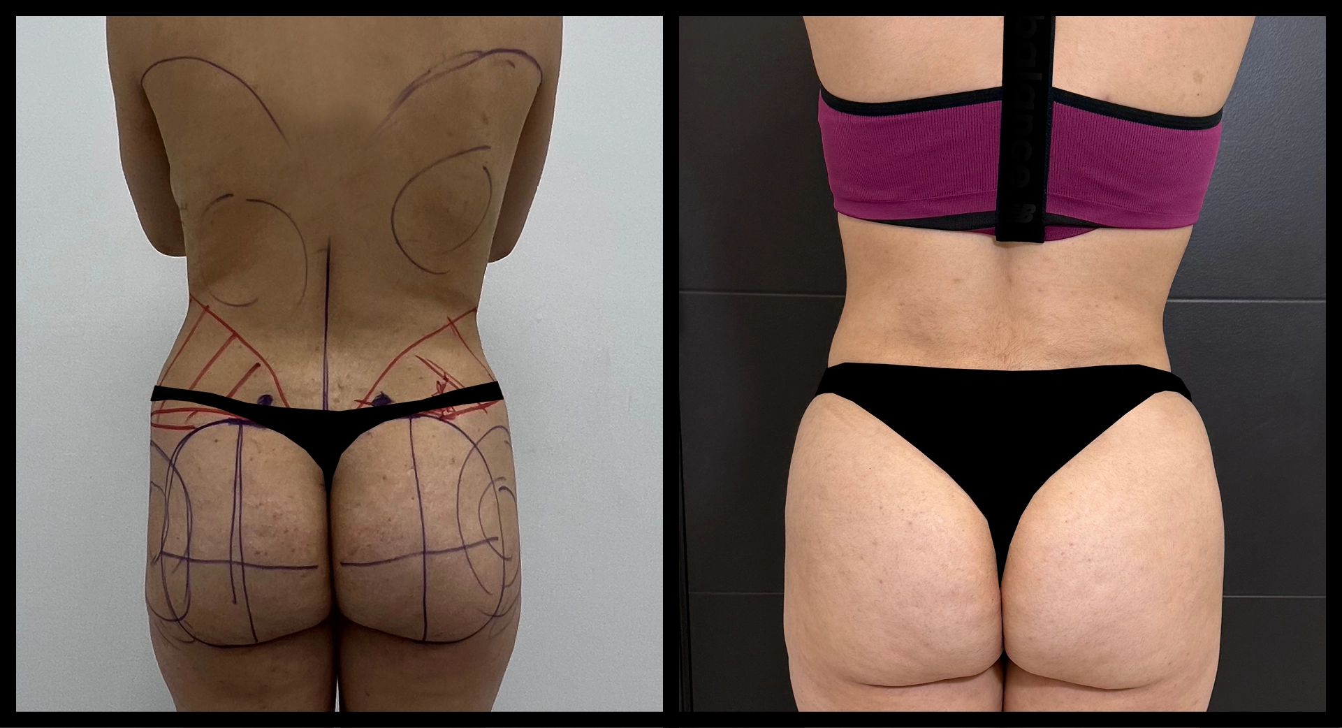BBL Reversal before and after photo 8 - safe reduction results at Elevé Cosmetic Surgery Miami