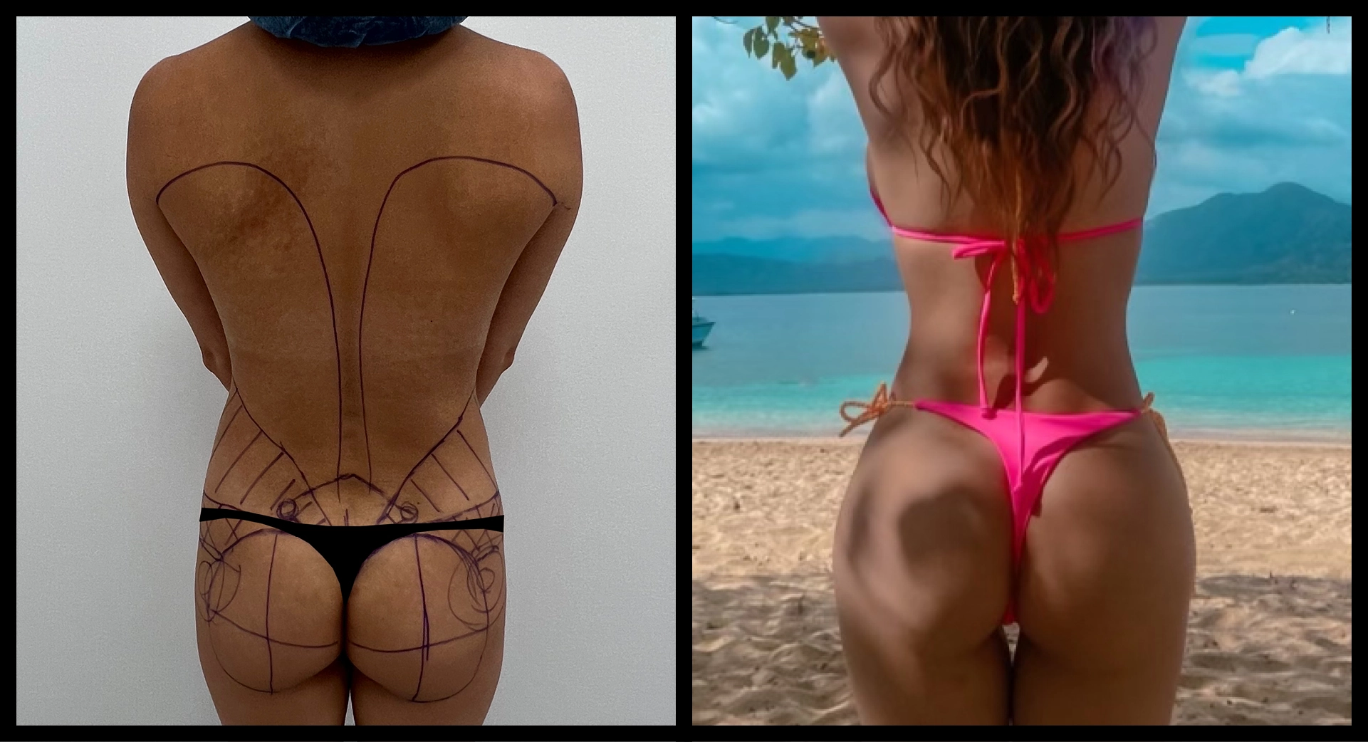 BBL Reversal before and after photo 9 - safe reduction results at Elevé Cosmetic Surgery Miami