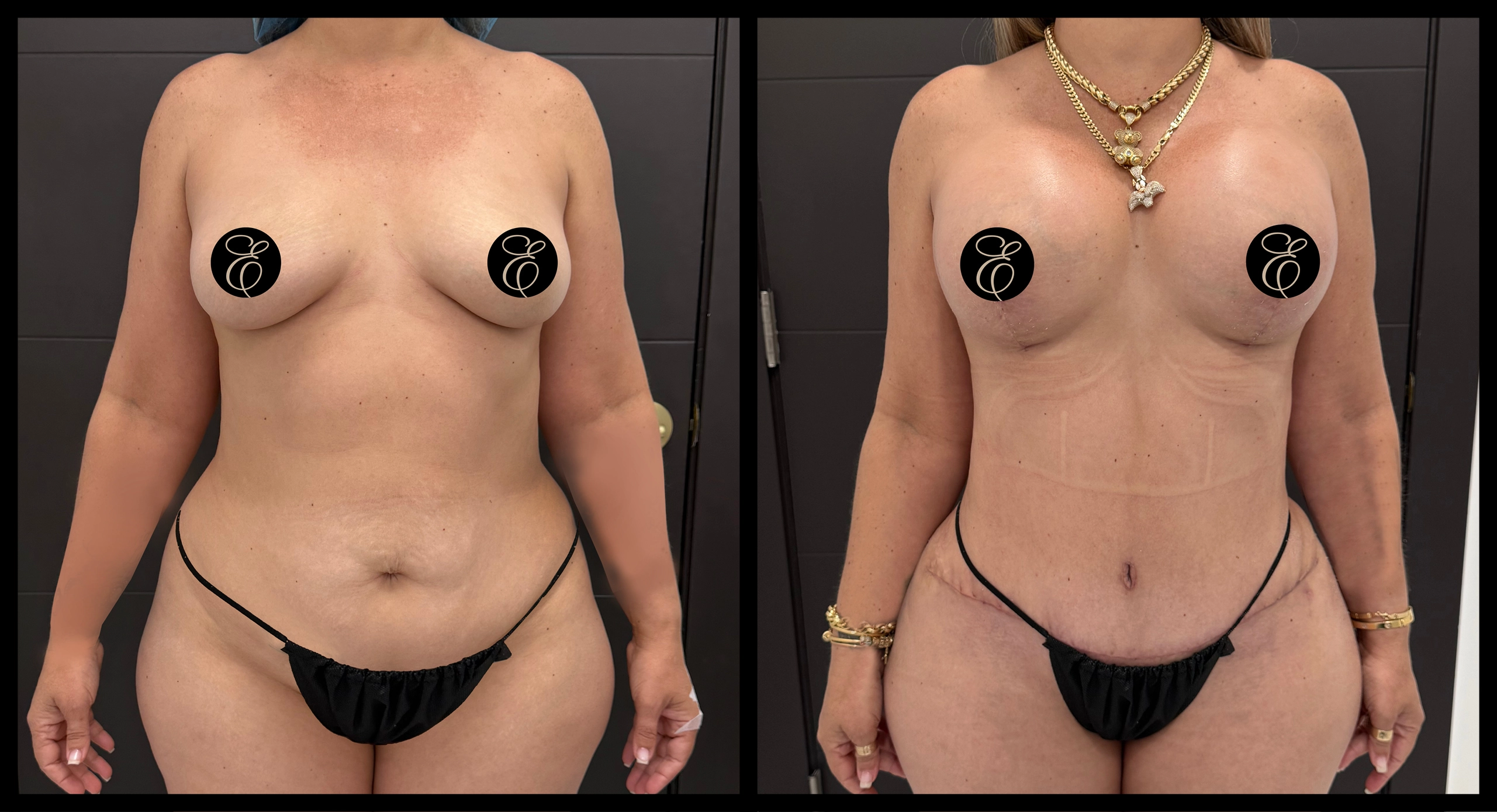 Breast Lift before and after photo 1 - youthful lifting results at Elevé Cosmetic Surgery Miami