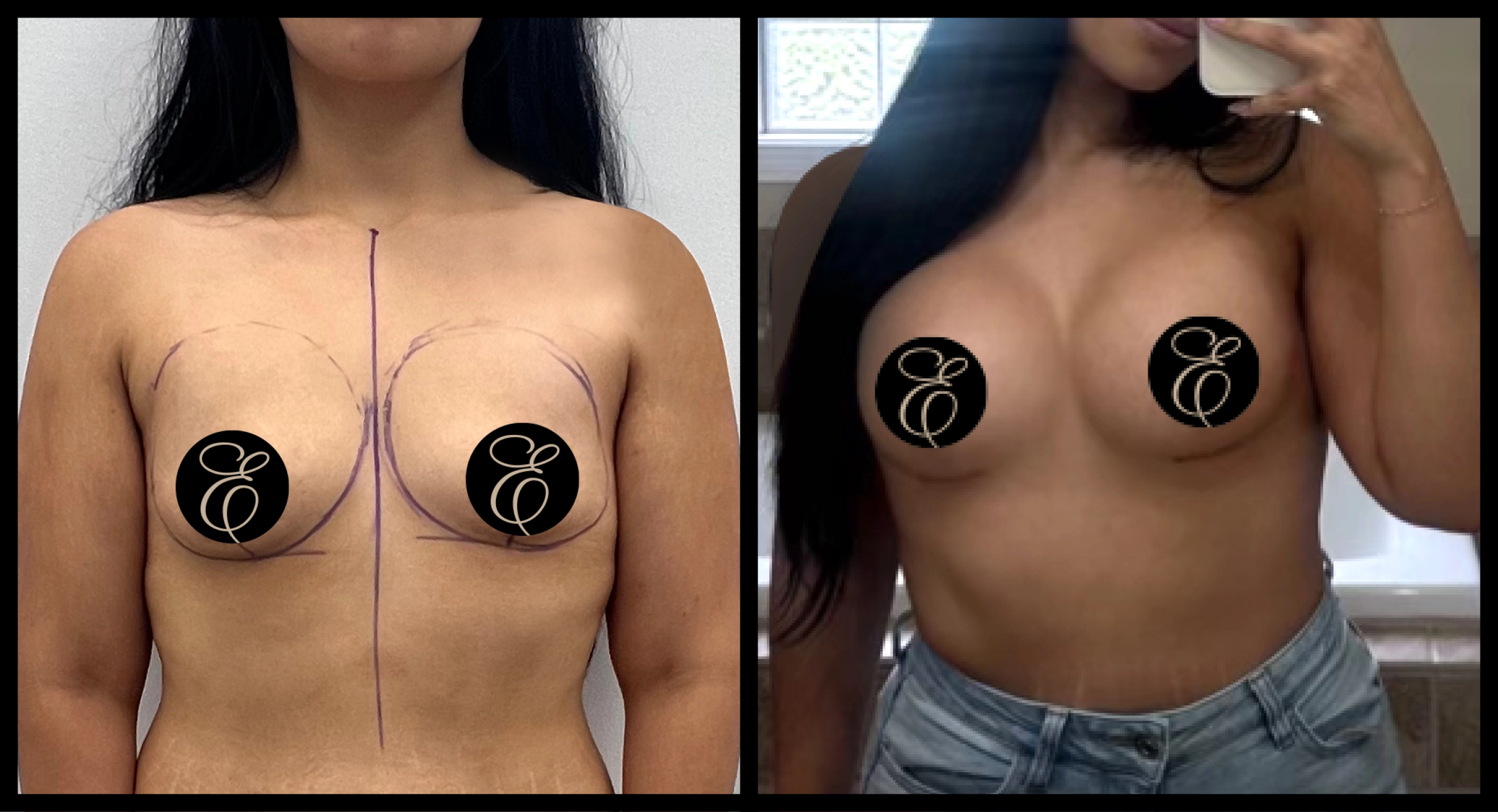 Breast Lift before and after photo 2 - youthful lifting results at Elevé Cosmetic Surgery Miami