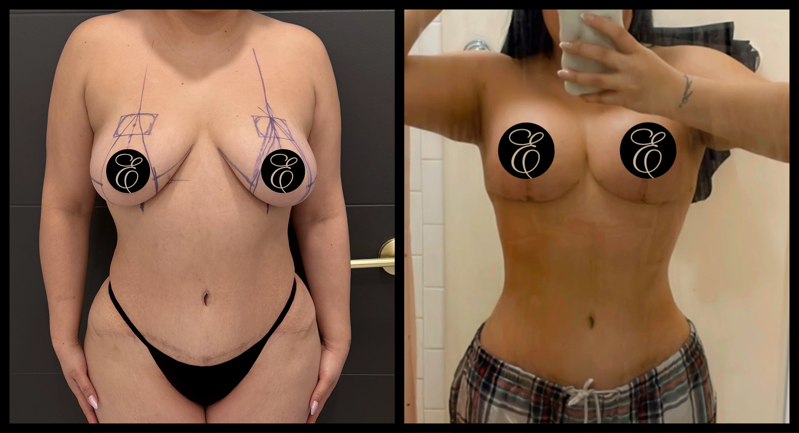 Breast Lift before and after photo 3 - youthful lifting results at Elevé Cosmetic Surgery Miami