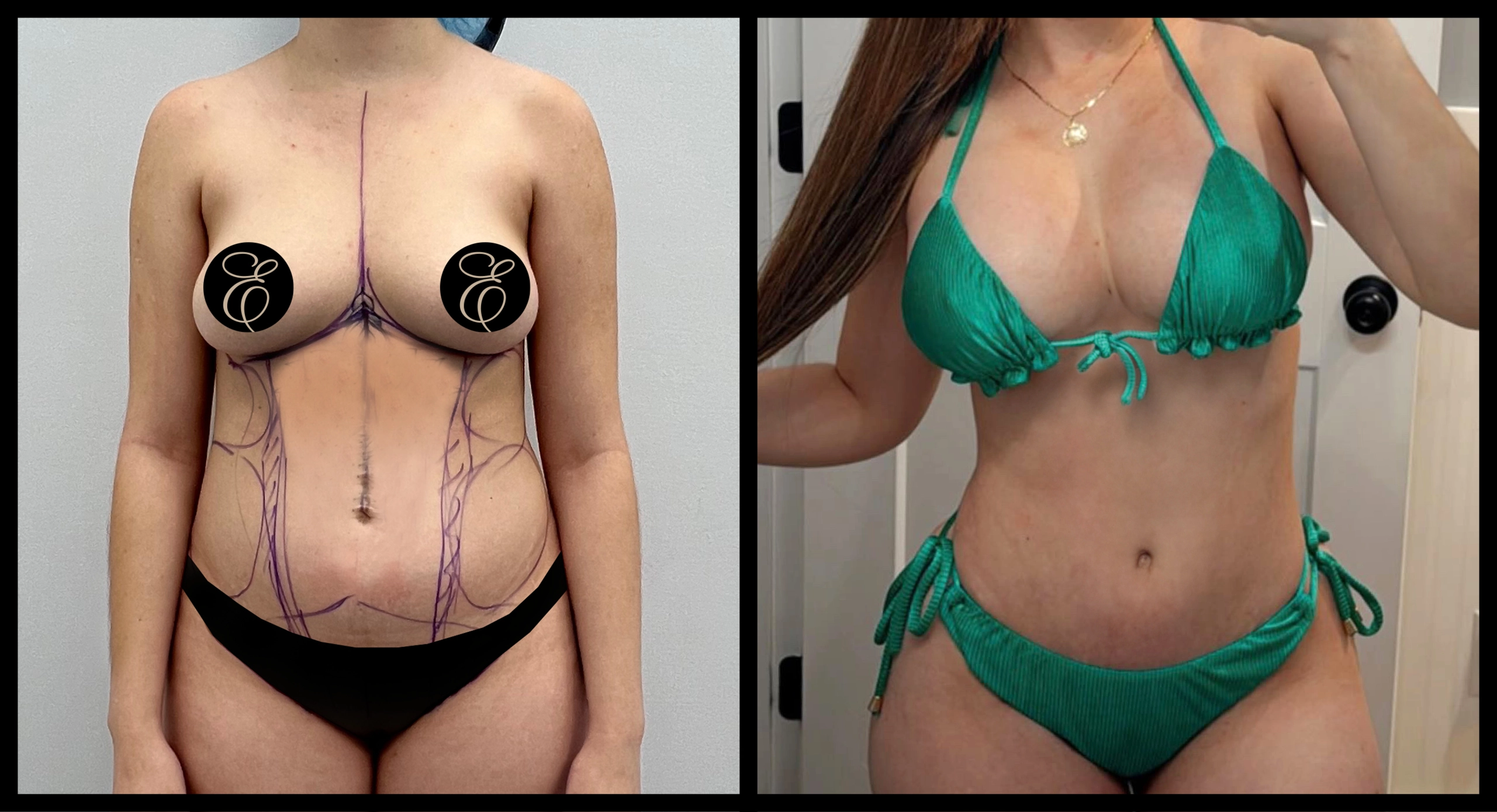 Liposuction before and after photo 2 - fat removal and body contouring transformation results at Elevé Cosmetic Surgery Miami