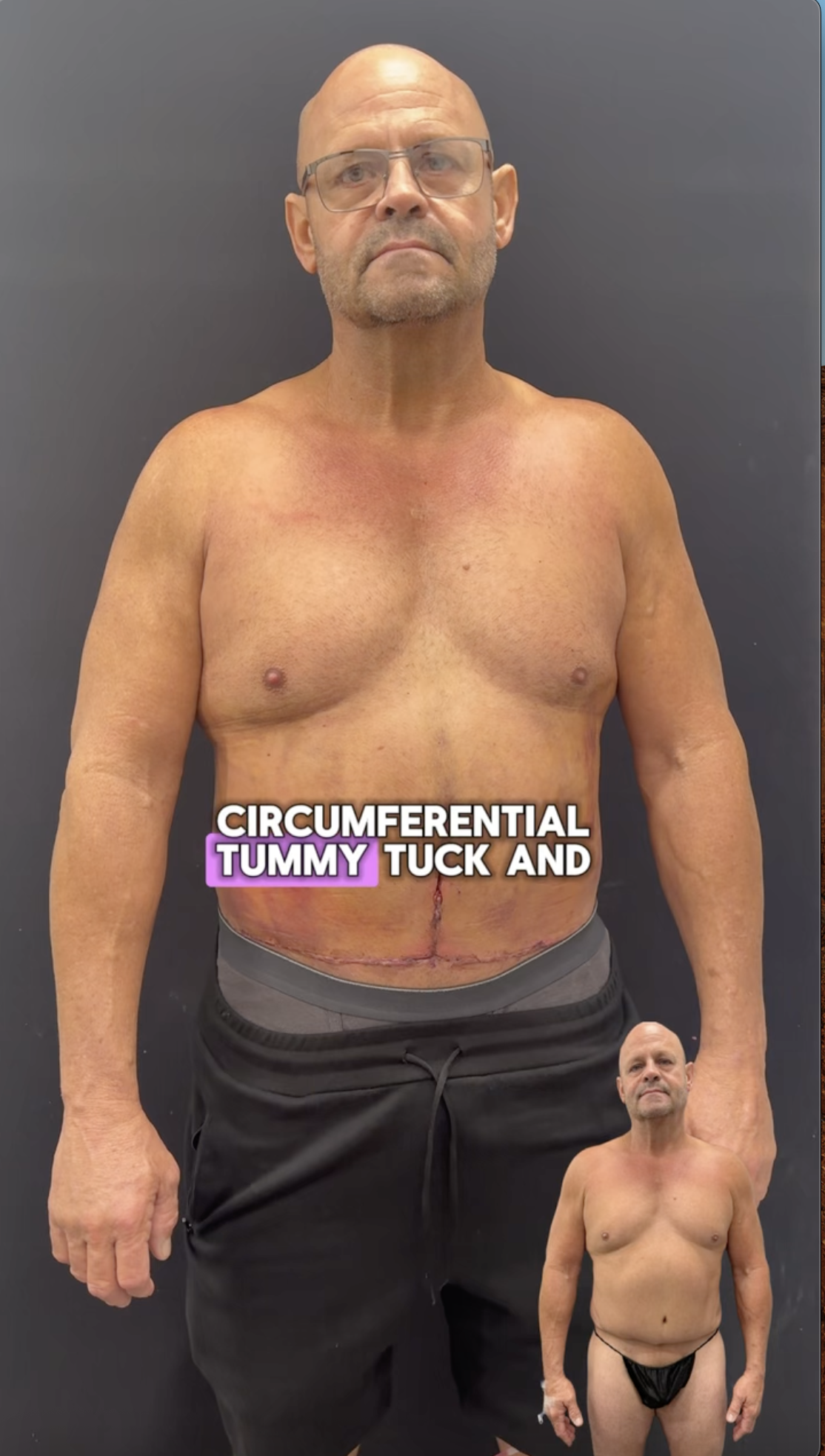 Antonio's skin removal transformation at Elevé Cosmetic Surgery