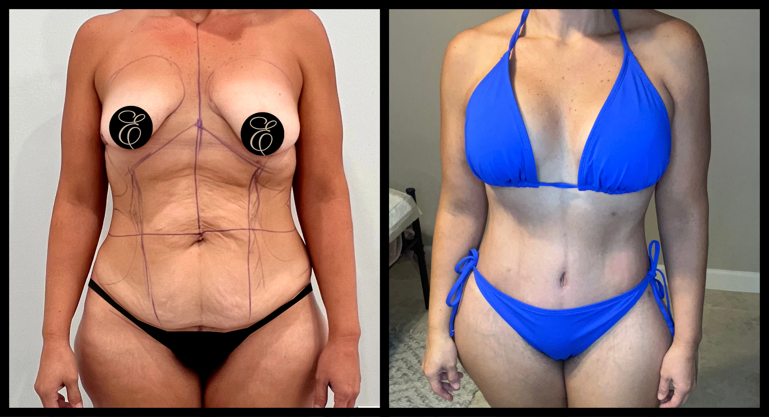 High Definition Tummy Tuck before and after photo 1 - sculpted abdominal results at Elevé Cosmetic Surgery Miami