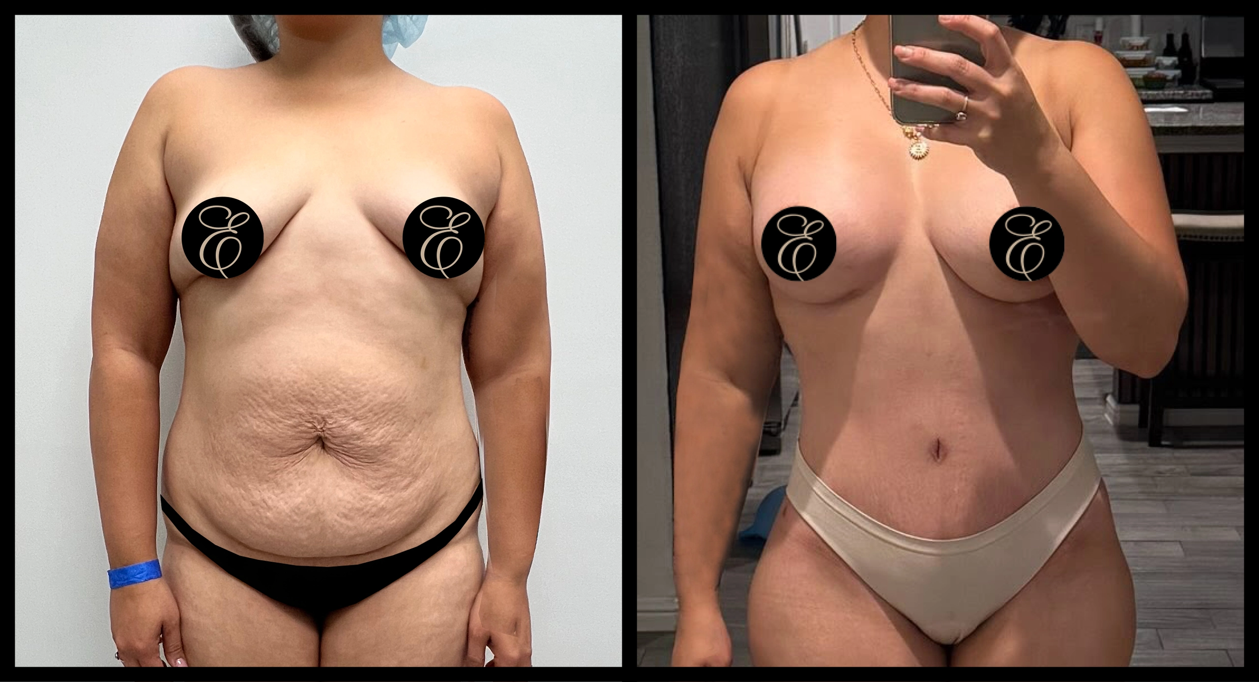 High Definition Tummy Tuck before and after photo 2 - sculpted abdominal results at Elevé Cosmetic Surgery Miami