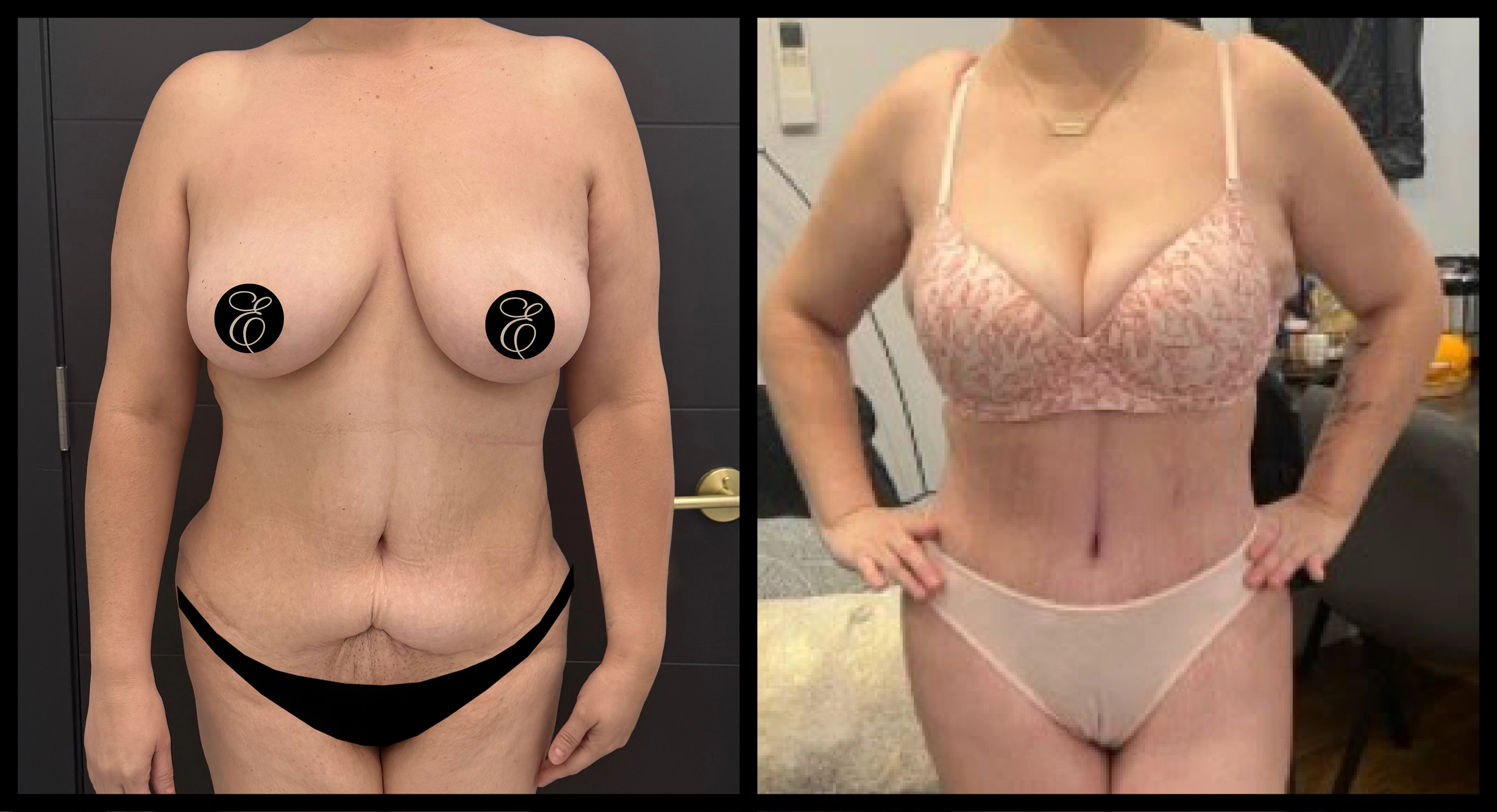 High Definition Tummy Tuck before and after photo 3 - sculpted abdominal results at Elevé Cosmetic Surgery Miami