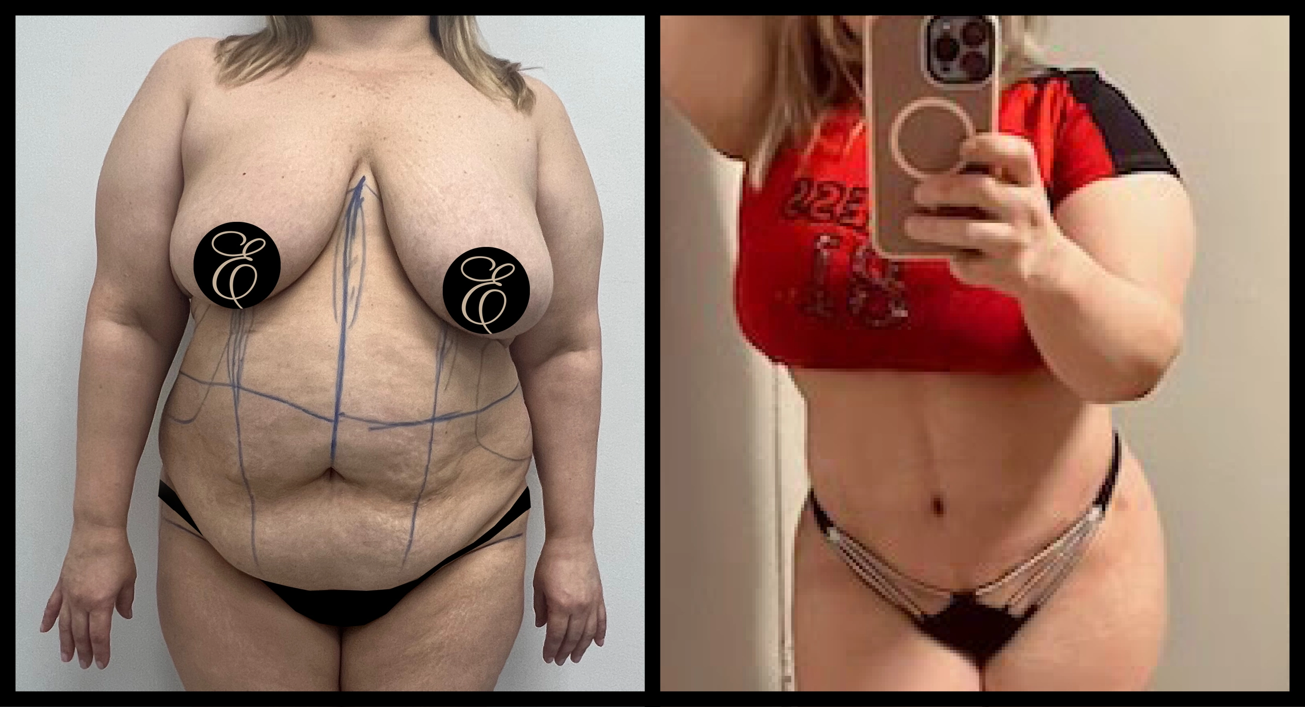 High Definition Tummy Tuck before and after photo 4 - sculpted abdominal results at Elevé Cosmetic Surgery Miami