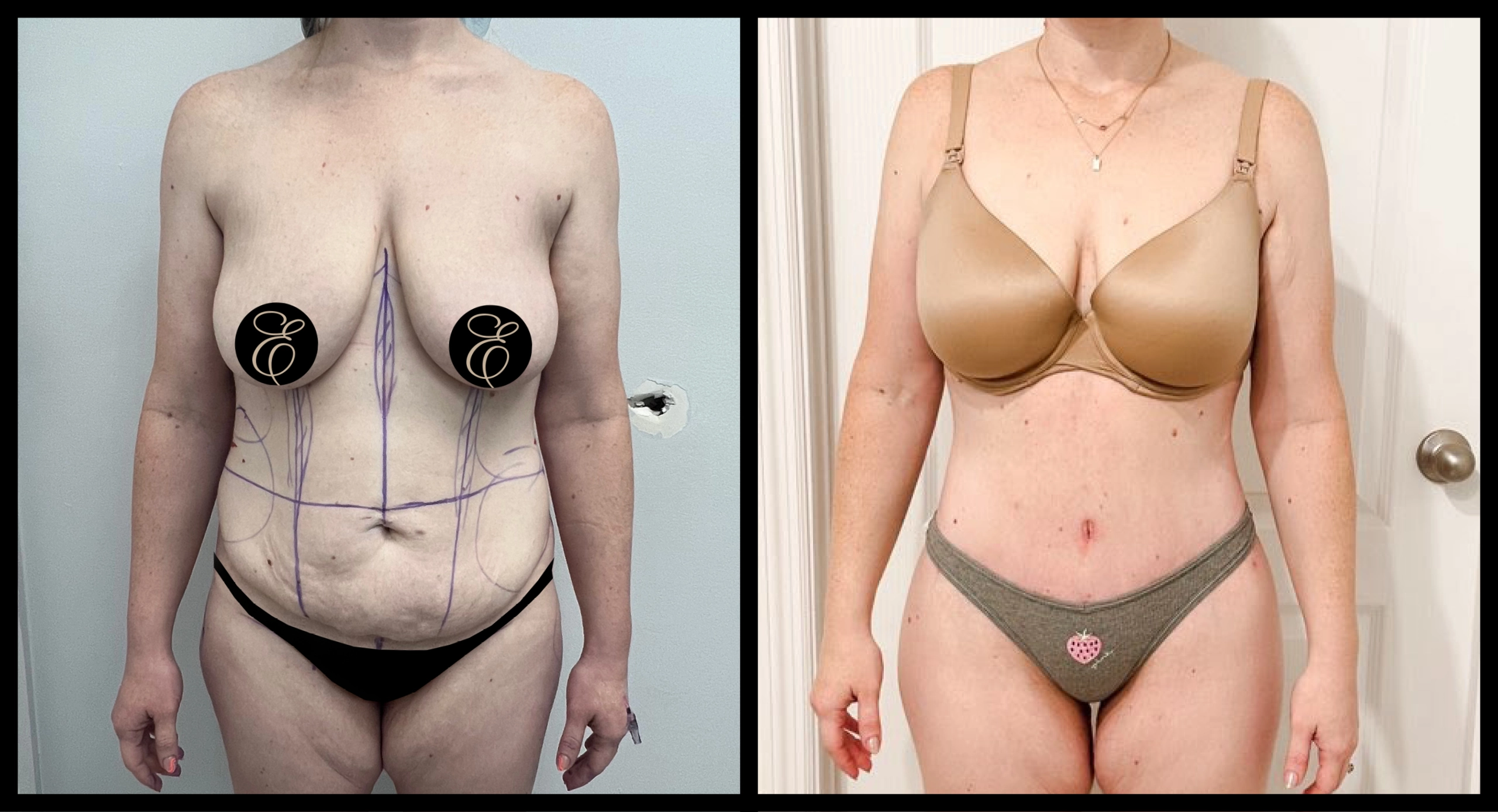 High Definition Tummy Tuck before and after photo 5 - sculpted abdominal results at Elevé Cosmetic Surgery Miami