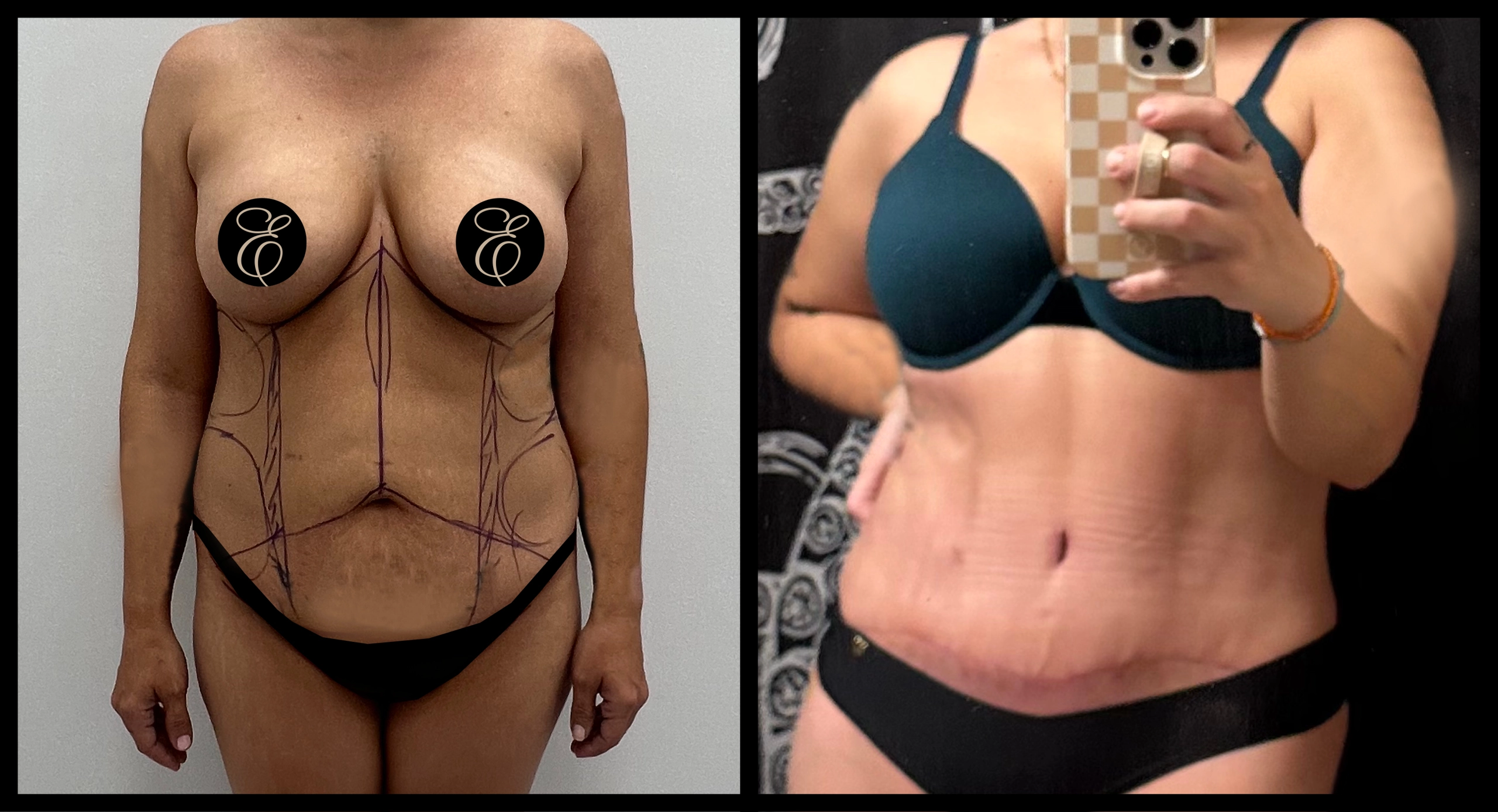 High Definition Tummy Tuck before and after photo 6 - sculpted abdominal results at Elevé Cosmetic Surgery Miami
