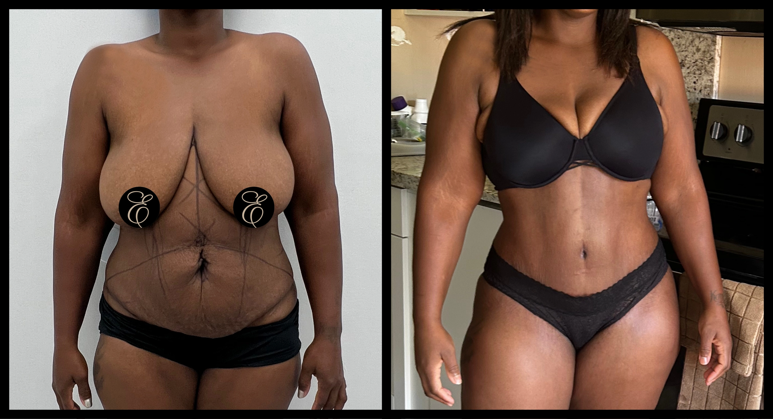 High Definition Tummy Tuck before and after photo 7 - sculpted abdominal results at Elevé Cosmetic Surgery Miami