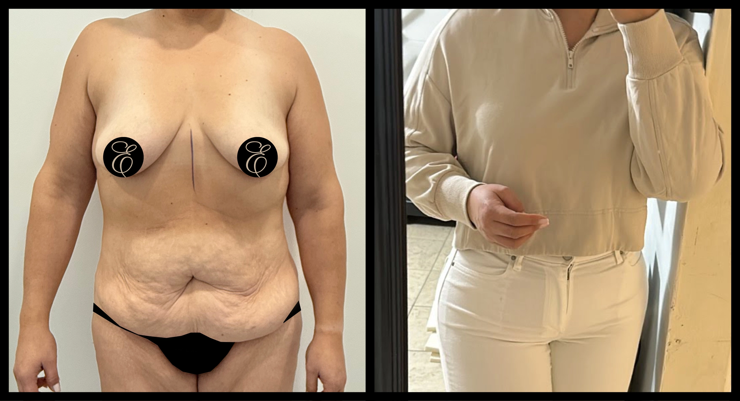 High Definition Tummy Tuck before and after photo 8 - sculpted abdominal results at Elevé Cosmetic Surgery Miami