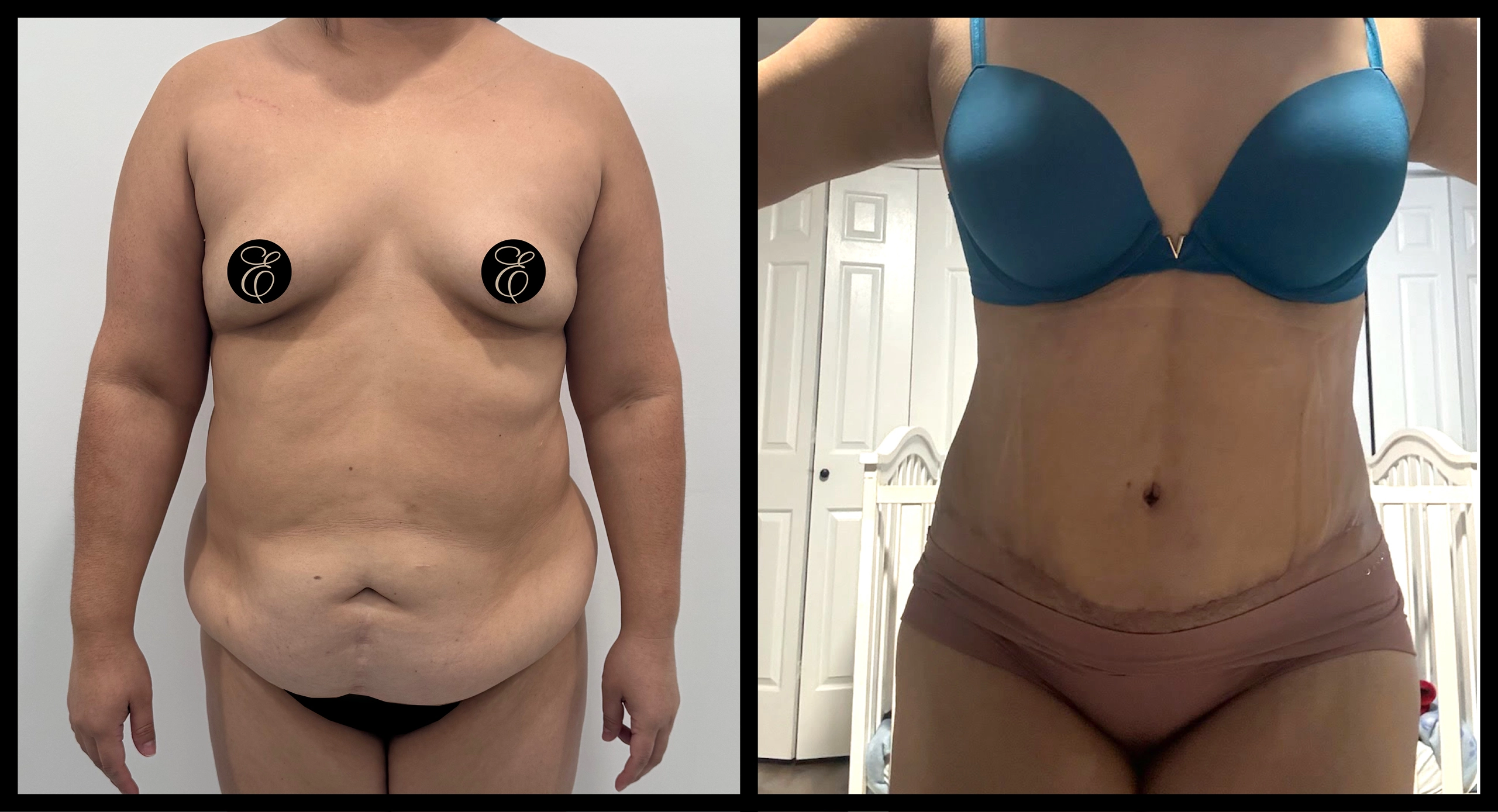 High Definition Tummy Tuck before and after photo 9 - sculpted abdominal results at Elevé Cosmetic Surgery Miami