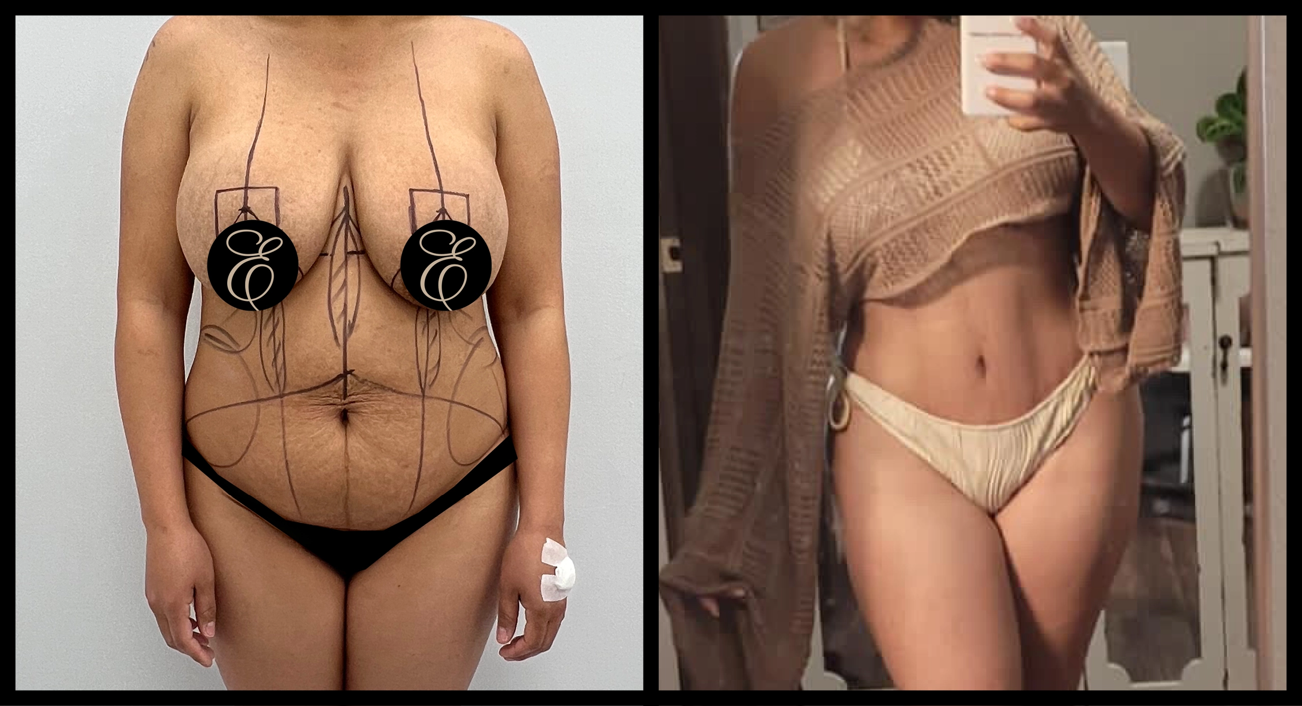High Definition Tummy Tuck before and after photo 10 - sculpted abdominal results at Elevé Cosmetic Surgery Miami
