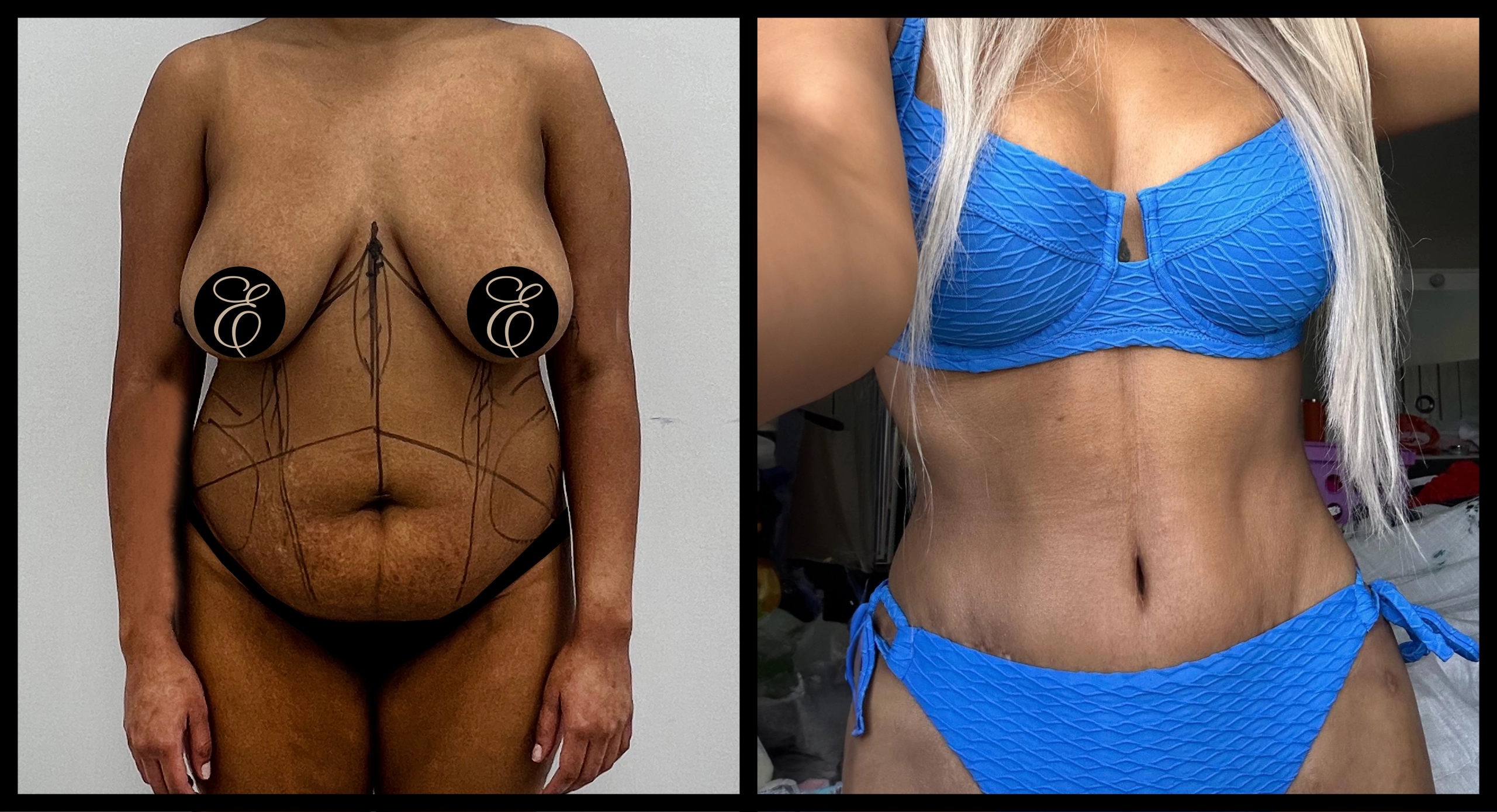 High Definition Tummy Tuck before and after photo 11 - sculpted abdominal results at Elevé Cosmetic Surgery Miami
