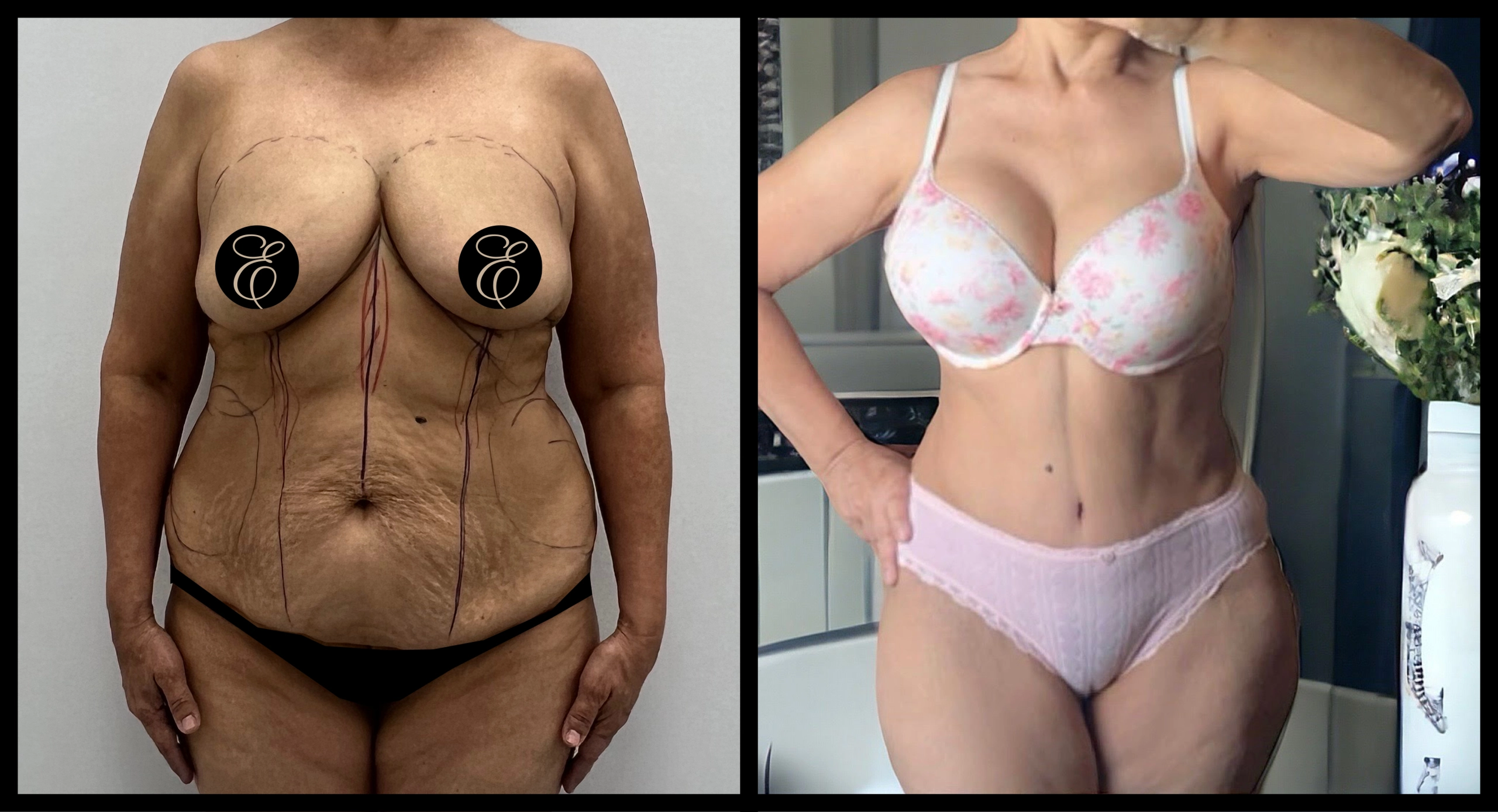 High Definition Tummy Tuck before and after photo 12 - sculpted abdominal results at Elevé Cosmetic Surgery Miami