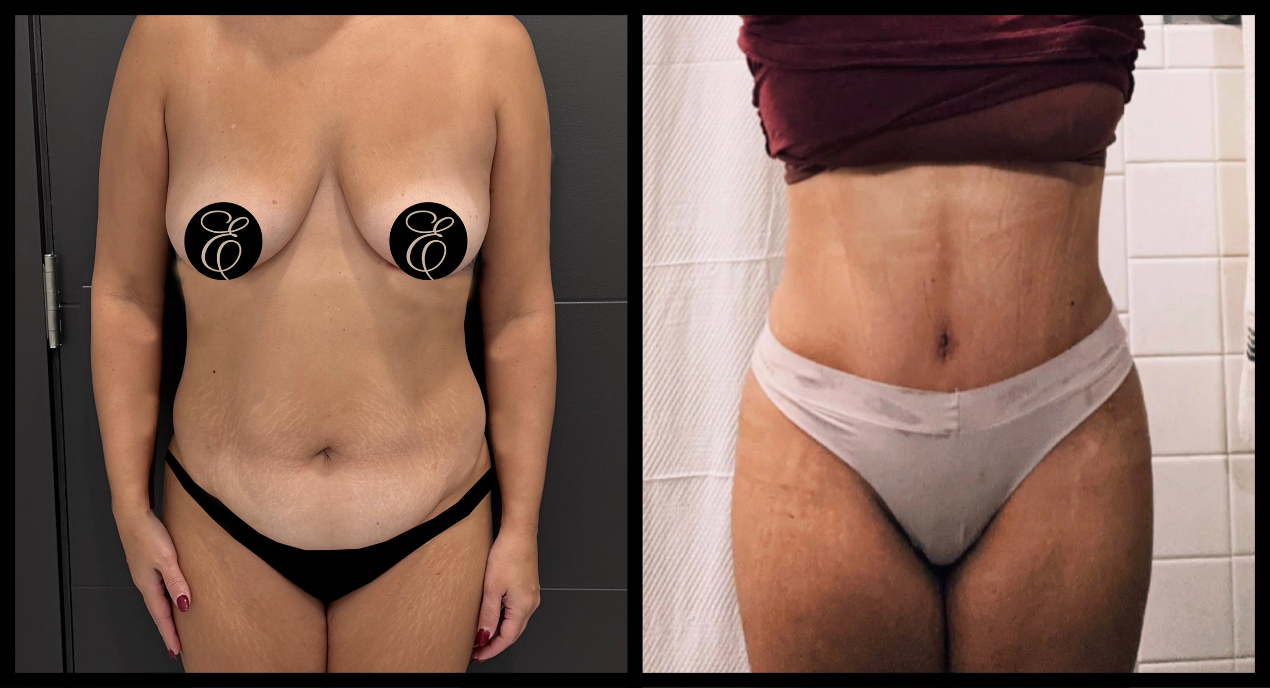 High Definition Tummy Tuck before and after photo 13 - sculpted abdominal results at Elevé Cosmetic Surgery Miami