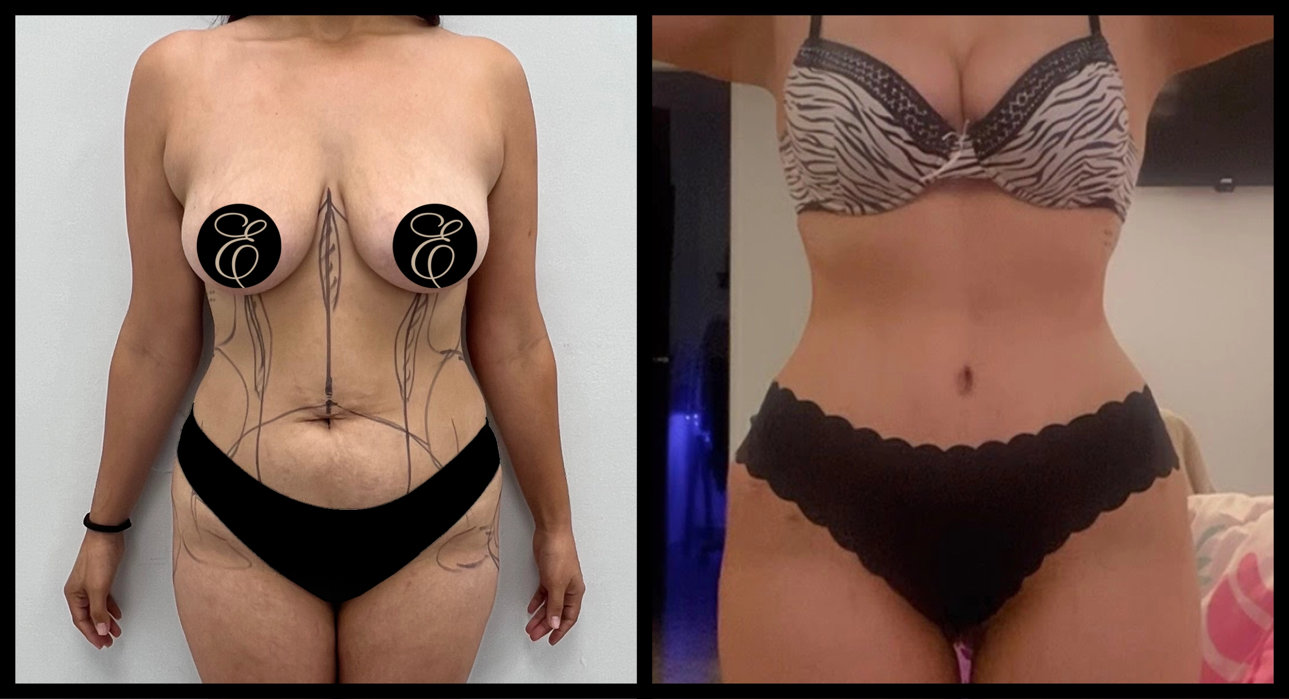High Definition Tummy Tuck before and after photo 14 - sculpted abdominal results at Elevé Cosmetic Surgery Miami