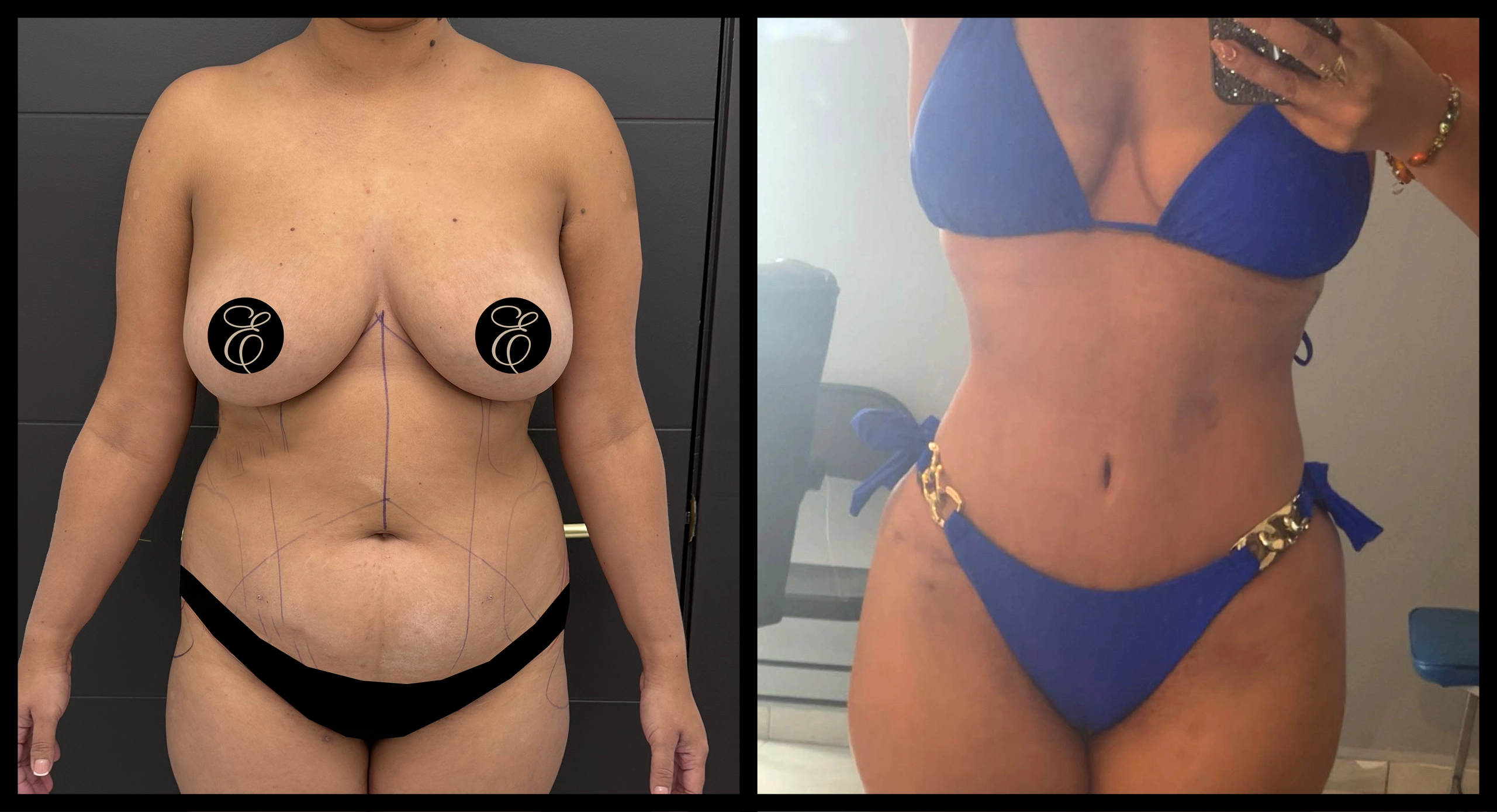 High Definition Tummy Tuck before and after photo 15 - sculpted abdominal results at Elevé Cosmetic Surgery Miami