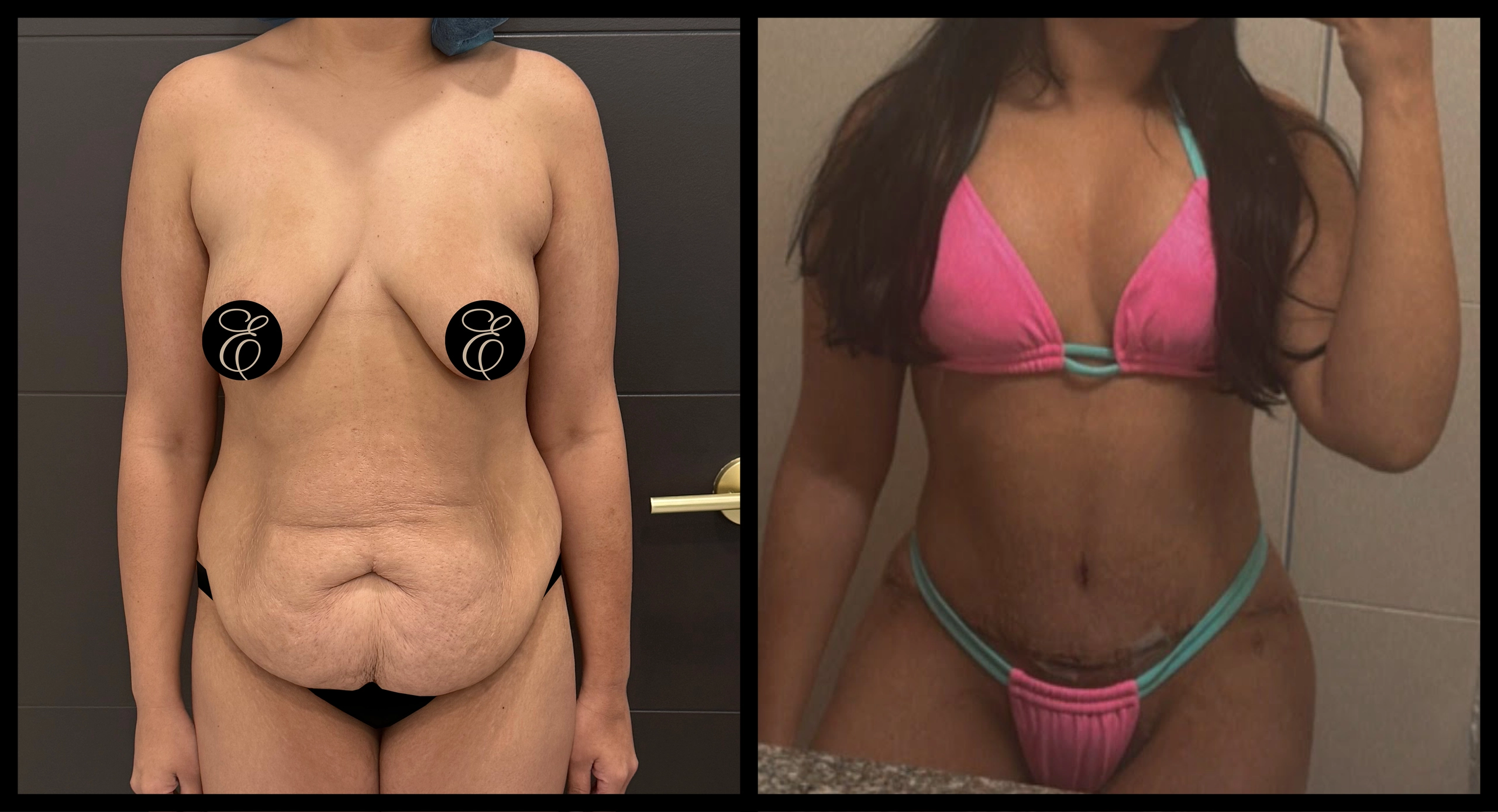 High Definition Tummy Tuck before and after photo 17 - sculpted abdominal results at Elevé Cosmetic Surgery Miami