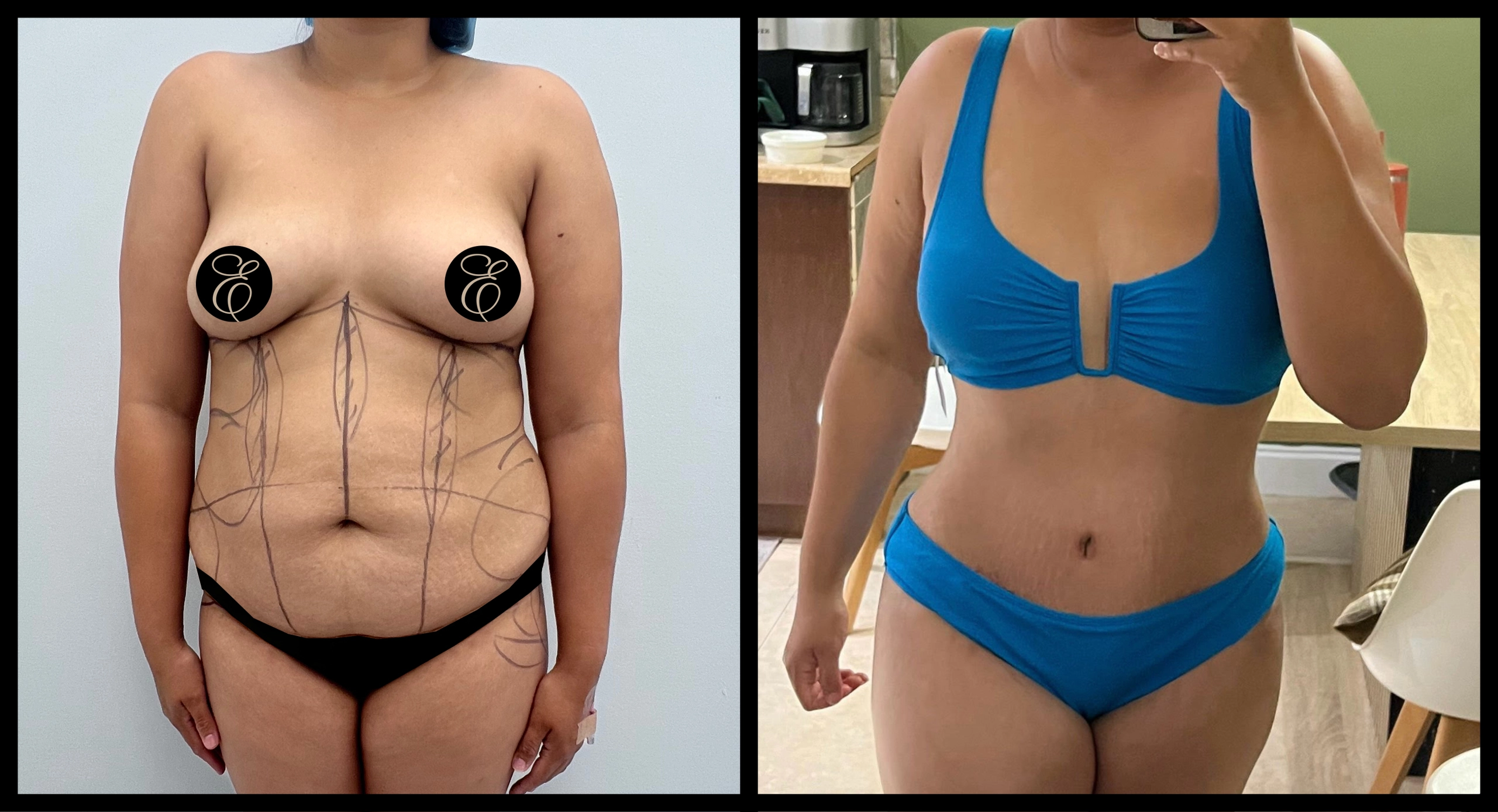 High Definition Tummy Tuck before and after photo 18 - sculpted abdominal results at Elevé Cosmetic Surgery Miami