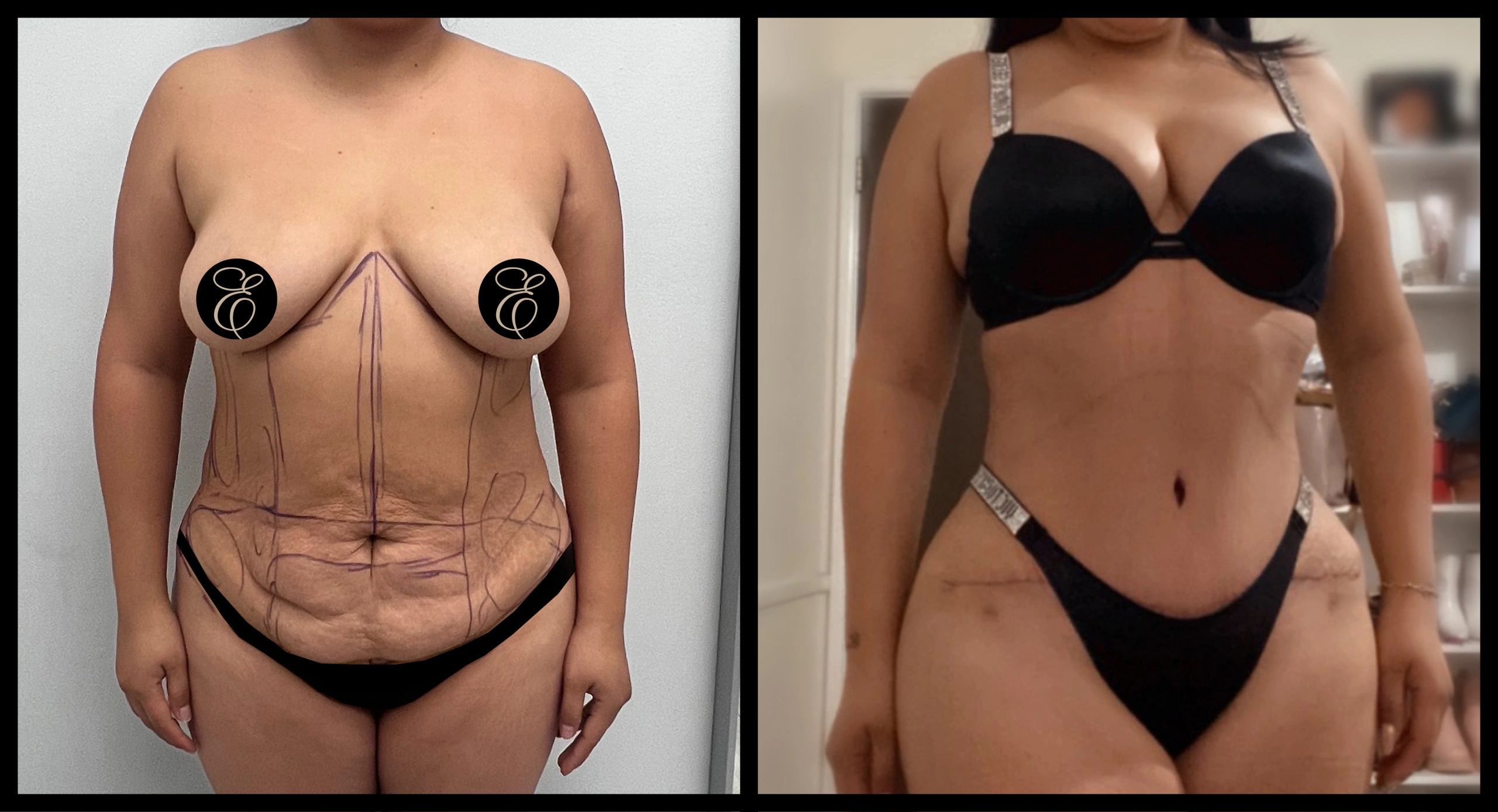 High Definition Tummy Tuck before and after photo 19 - sculpted abdominal results at Elevé Cosmetic Surgery Miami